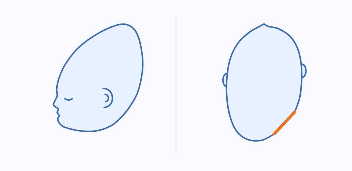 Diagram of a cone-shaped newborn head from the side next to a head with a flat spot at the back seen from above