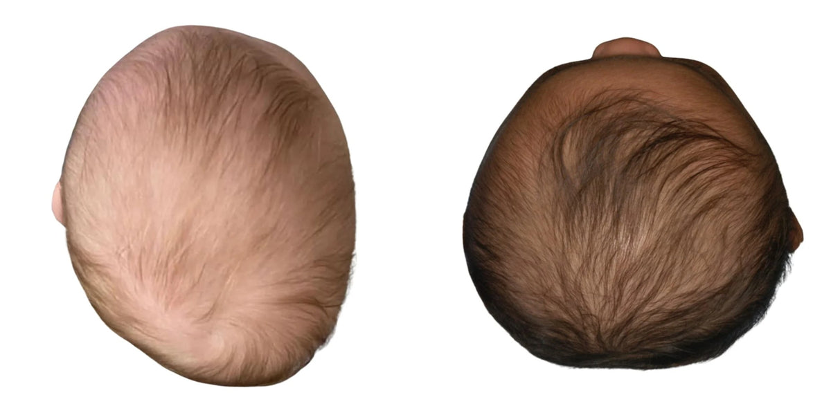 Two baby heads seen from above, one flatter on one side at the back and one flat across the back and wide