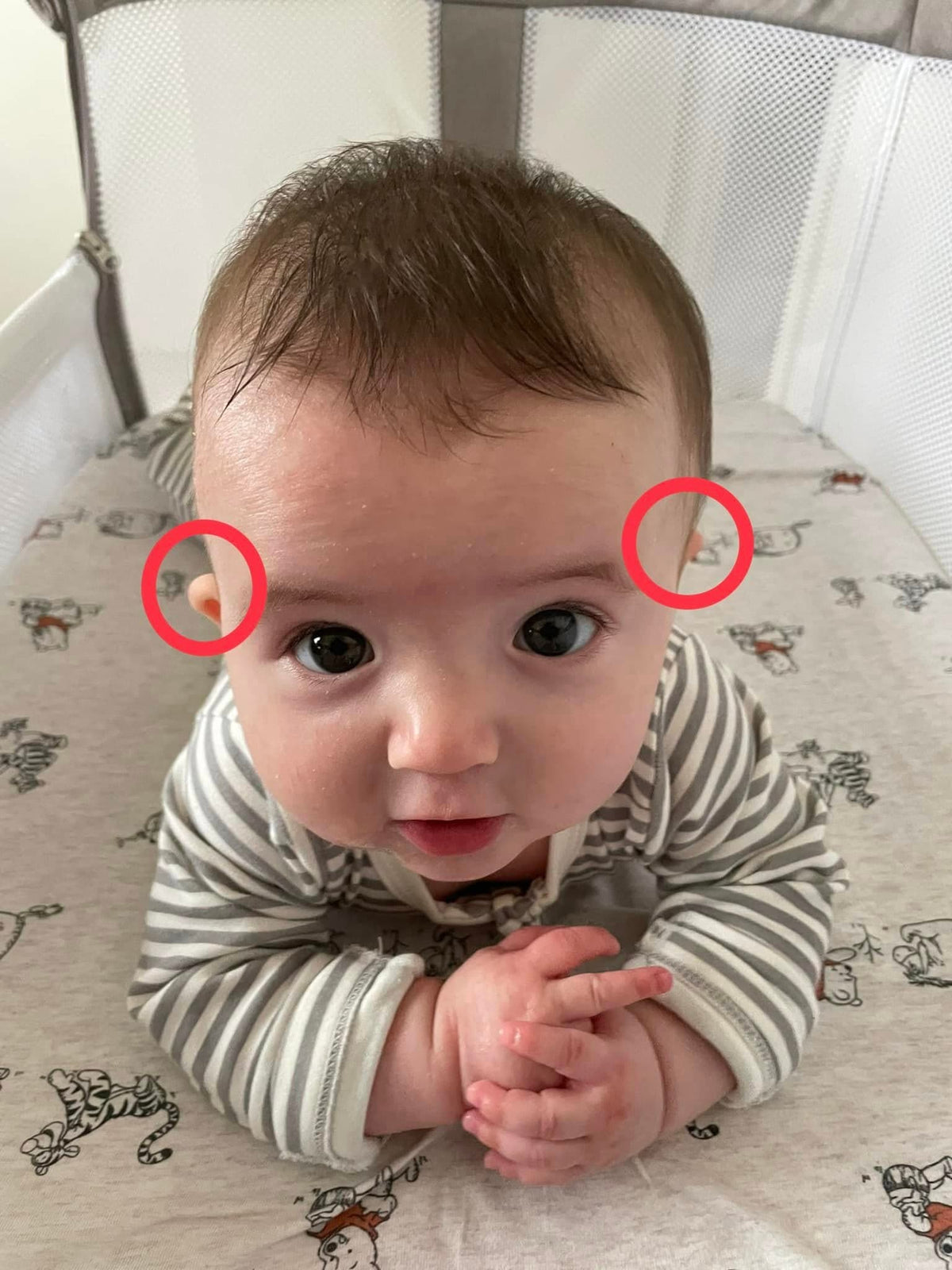 Baby's face viewed straight on, showing the forehead and cheek on the flattened side sitting slightly further forward